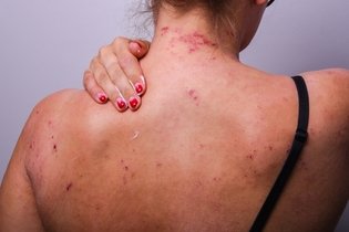 Imagem ilustrativa do artigo Dermatite atópica grave: o que é, sintomas, causas e tratamento