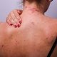 Dermatite atópica grave: o que é, sintomas, causas e tratamento