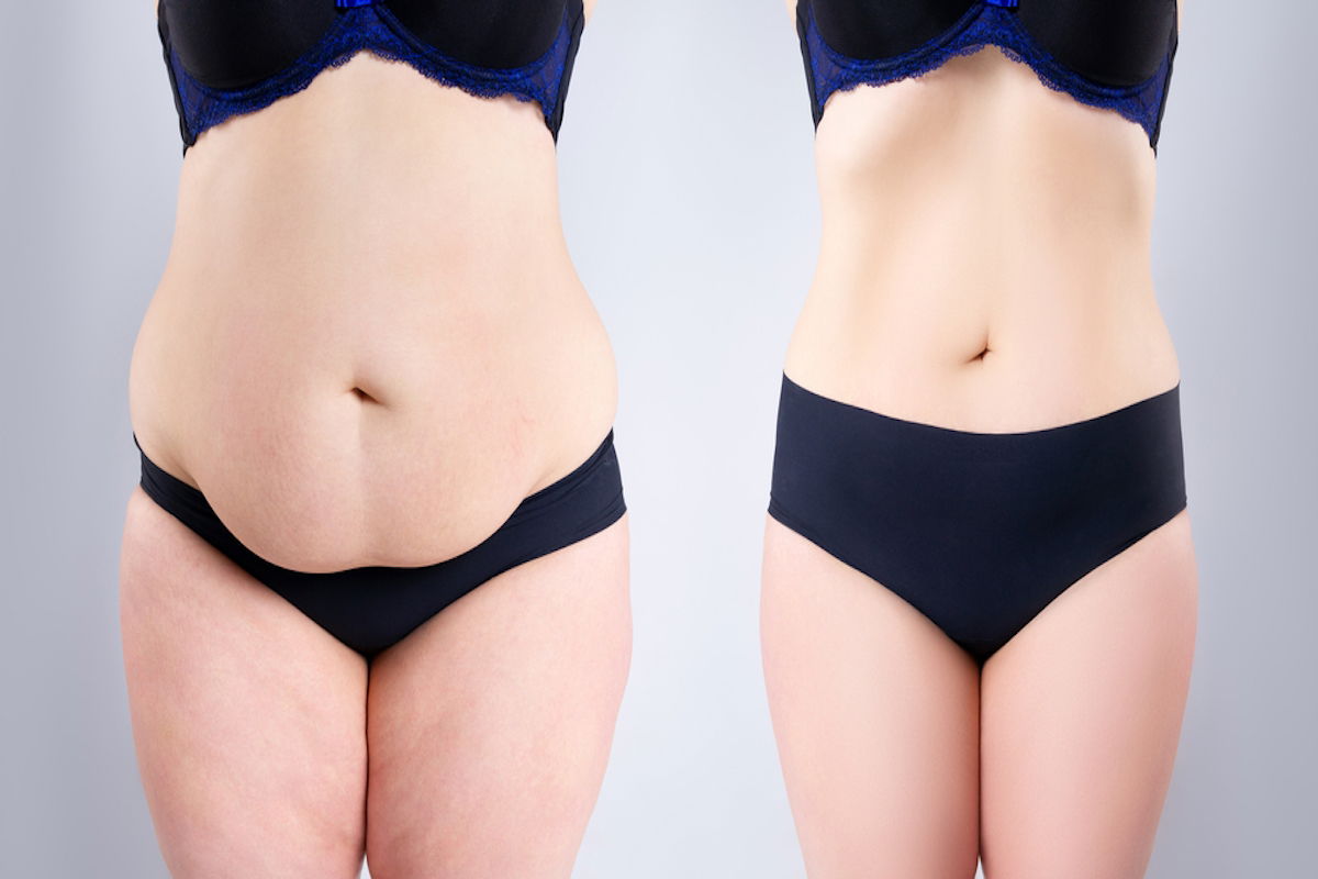Antes y después de la abdominoplastia