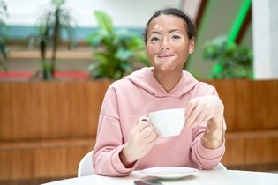 Imagen ilustrativa del artículo 10 síntomas de vitiligo (y qué hacer)