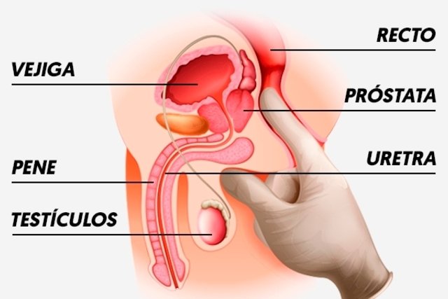 como se realiza el examen de próstata