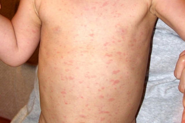 Infant Roseola What Is It Symptoms And Treatment Options Tua Saude