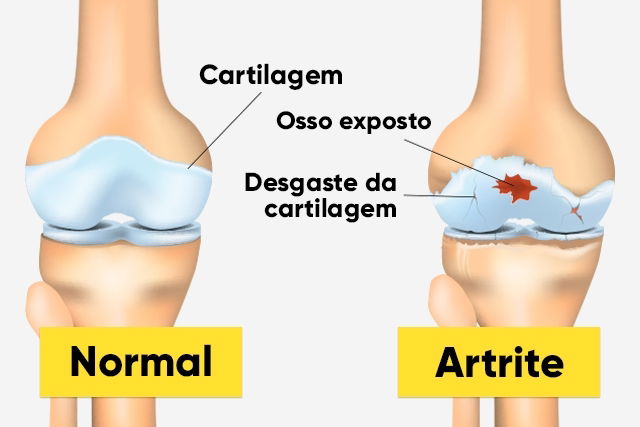 Resultado de imagem para sintomas da artrite