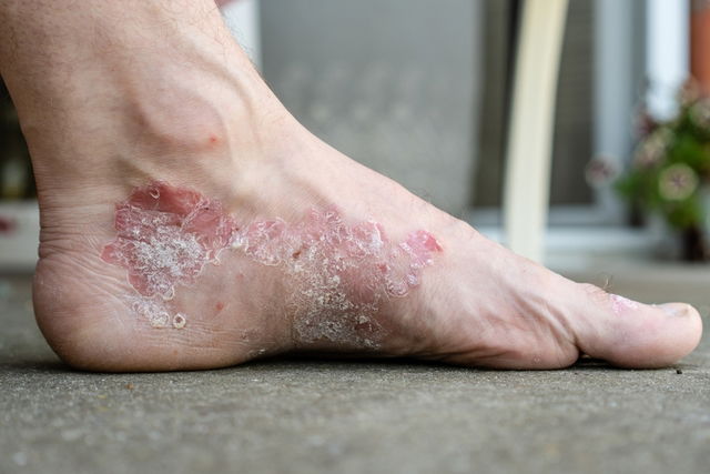 Peeling dead skin hot sale off feet