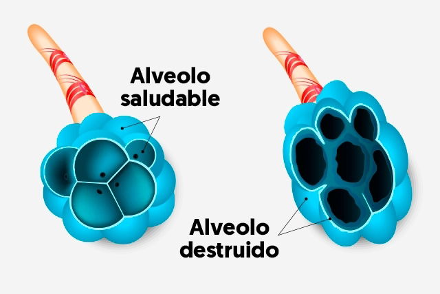 Enfisema pulmonar síntomas causas y tratamiento Desencadenado