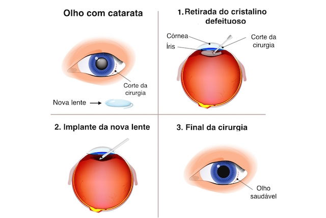 Novos Tratamentos Podem Ser Cura Definitiva E Segura Da Catarata Tua Sa De