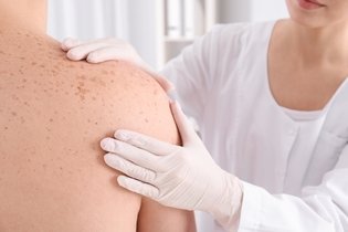 Imagem ilustrativa do artigo Toda verruga é HPV?