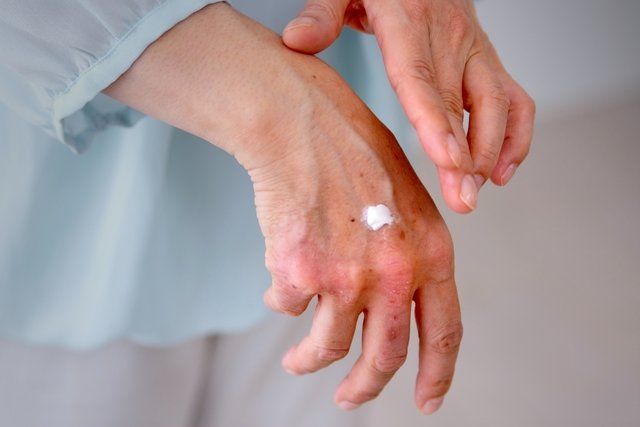 Imagem ilustrativa do artigo 9 principais causas de manchas de pele (e como tirar)