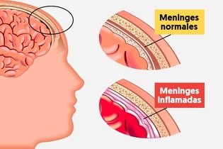 Imagen ilustrativa del artículo Meningitis meningocócica: qué es, síntomas y tratamiento