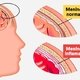 Meningitis meningocócica: qué es, síntomas y tratamiento