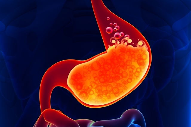 Como é feita a cirurgia para curar refluxo gastroesofágico