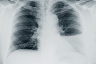 Imagem ilustrativa do artigo O que são estrias atelectásicas no pulmão?