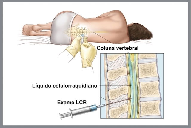 O que é punção lombar e quais os efeitos colaterais