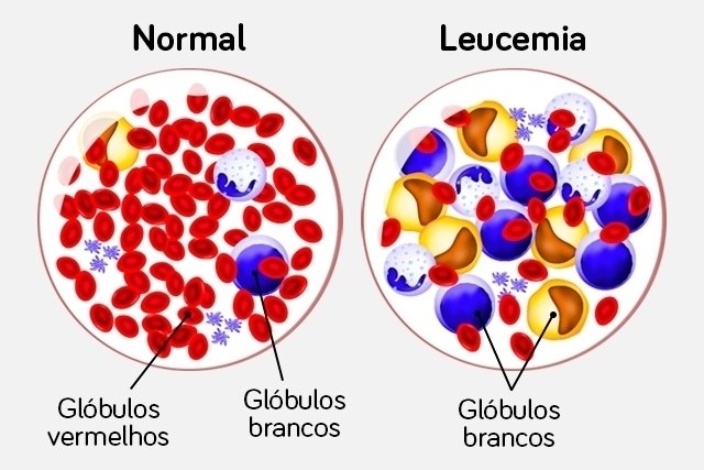 Alimentos prohibidos leucemia