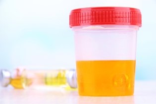 Proteína na urina (proteinúria): o que pode ser, sintomas e tratamento