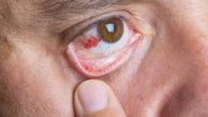 Derrame ocular: o que é, sintomas, causas e tratamento