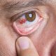 Derrame ocular: o que é, sintomas, causas e tratamento