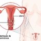 Anillo vaginal: qué es, para qué sirve y cómo usar