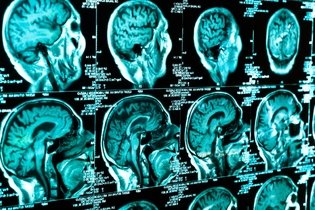 Traumatismo craniano: o que é, sintomas, tratamento e sequelas