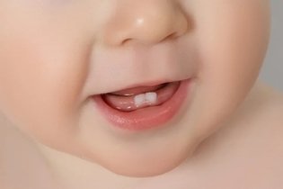 Imagen ilustrativa del artículo Nacimiento de los dientes: ¿qué síntomas provocan?