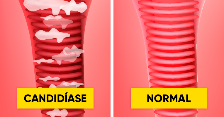 Sintomas De Candidíase Genital Na Garganta Na Pele E Intestinal Tua Saúde 5590