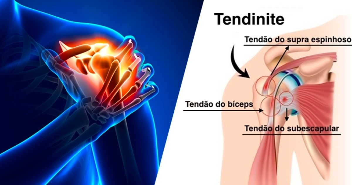 Tendinites E Tendinoses Do Ombro Tudo O Que Precisa Saber Para Se Mobile Legends