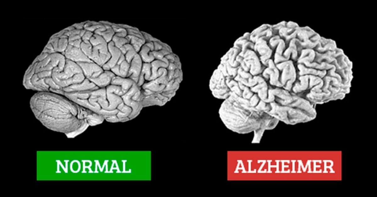 Resultado de imagem para alzheimer