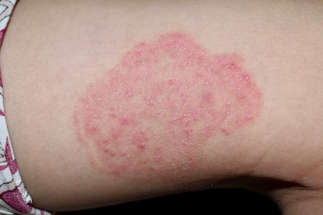 Perpetuo Entender mal ala Manchas Rojas en la piel: 18 causas y cómo quitarlas - Tua Saúde