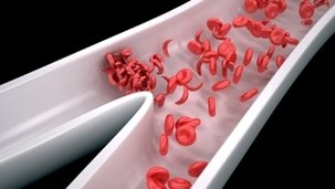 Saiba mais sobre o seu tipo de anemia imagem de destaque