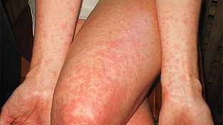 Entenda melhor a dengue hemorrágica imagem de destaque