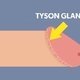 Tyson Glands: What Causes Them & Treatment